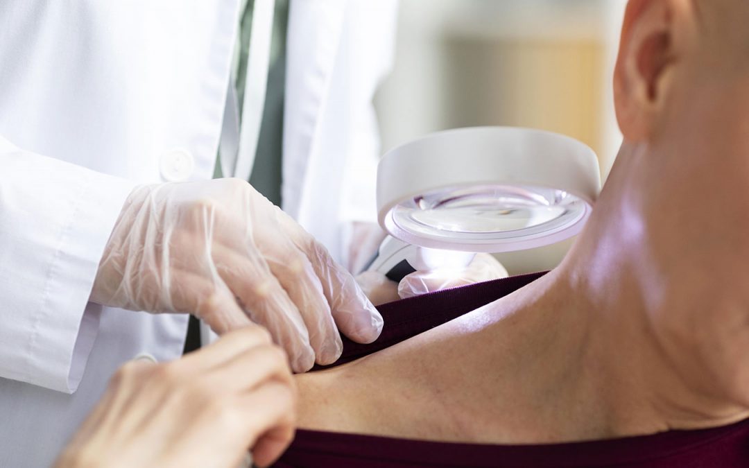 Radiation Dermatitis immufen gel skin cancer patients