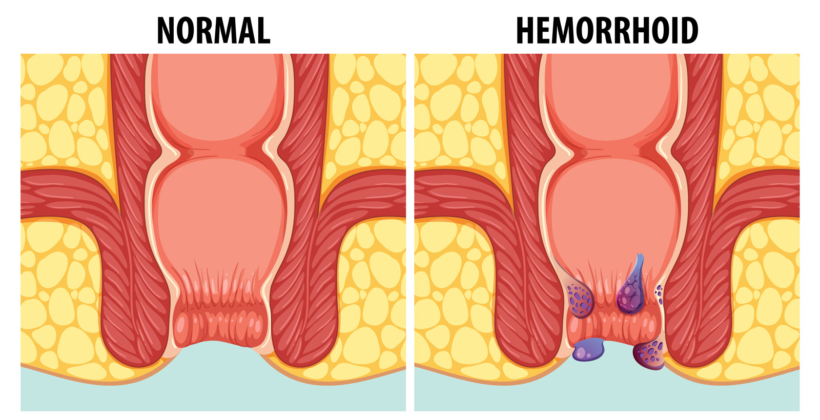 cause of hemorrhoids hemocyl treattment oral capsules